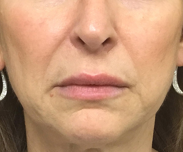 Dermal Fillers