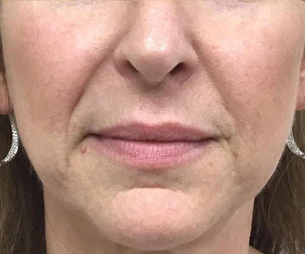 Dermal Fillers