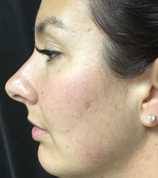 Rhinoplasty