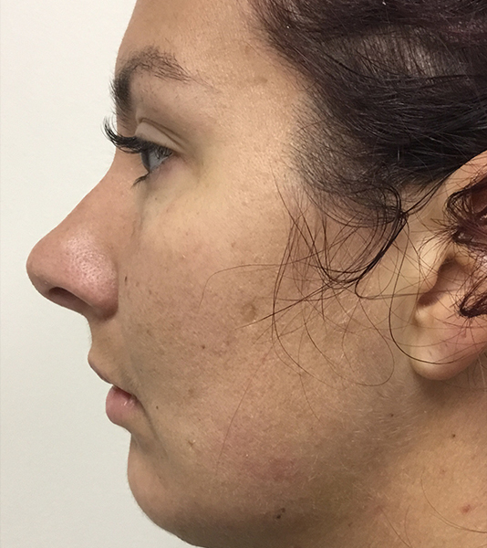 Rhinoplasty