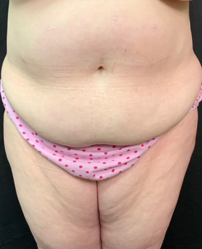 Abdominoplasty Before and After | Montilla Plastic Surgery 
