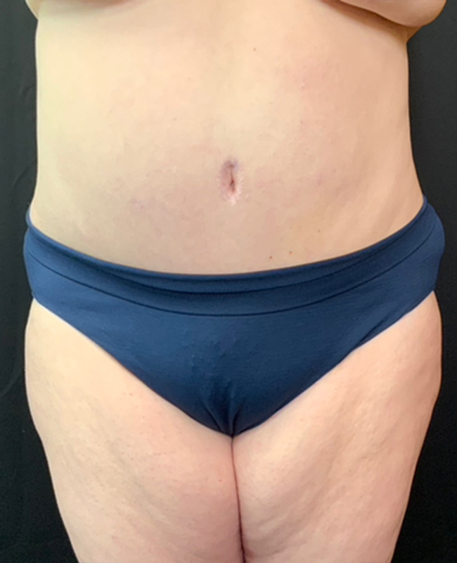 Abdominoplasty Before and After | Montilla Plastic Surgery 