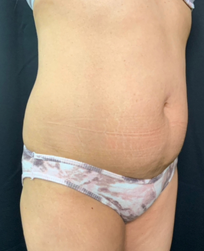 Abdominoplasty Before and After | Montilla Plastic Surgery 