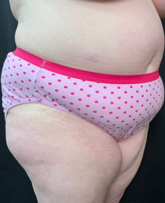 Abdominoplasty Before and After | Montilla Plastic Surgery 