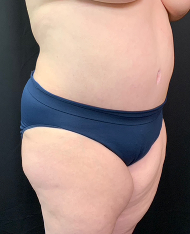Abdominoplasty Before and After | Montilla Plastic Surgery 