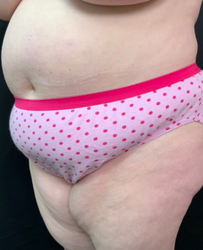 Abdominoplasty Before and After | Montilla Plastic Surgery 