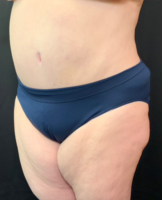 Abdominoplasty Before and After | Montilla Plastic Surgery 