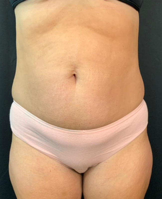 Abdominoplasty Before and After | Montilla Plastic Surgery 