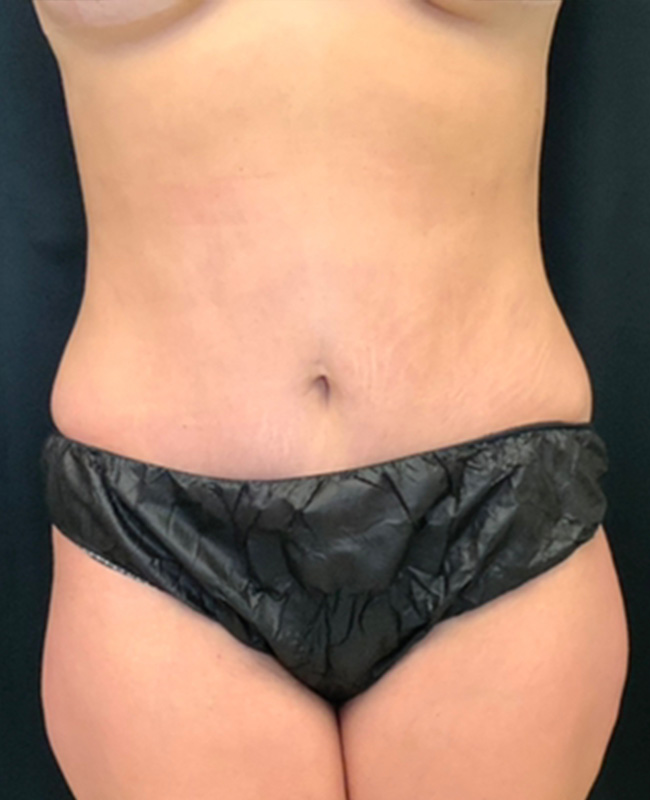 Abdominoplasty Before and After | Montilla Plastic Surgery 