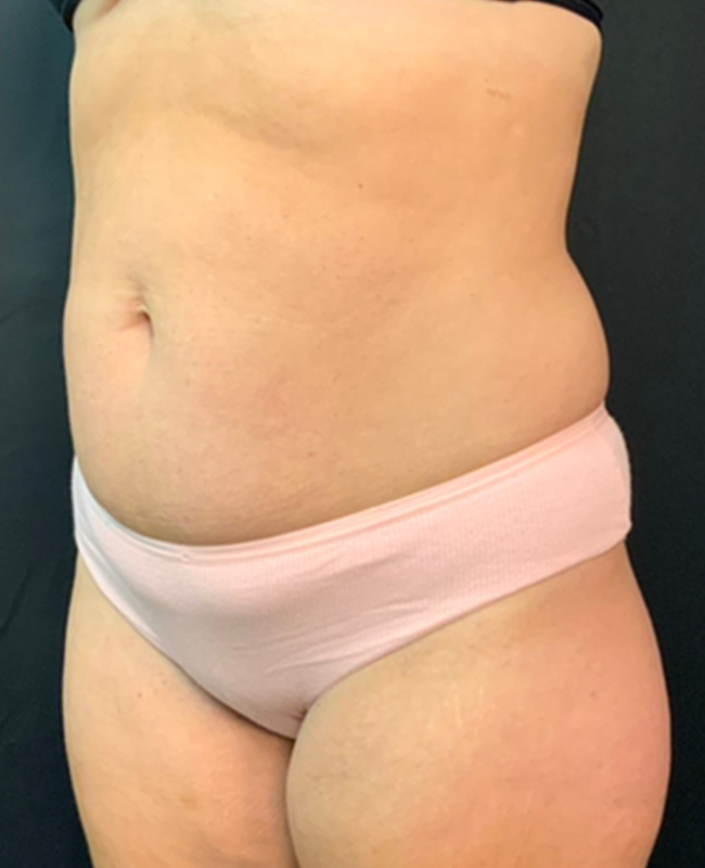 Abdominoplasty Before and After | Montilla Plastic Surgery 