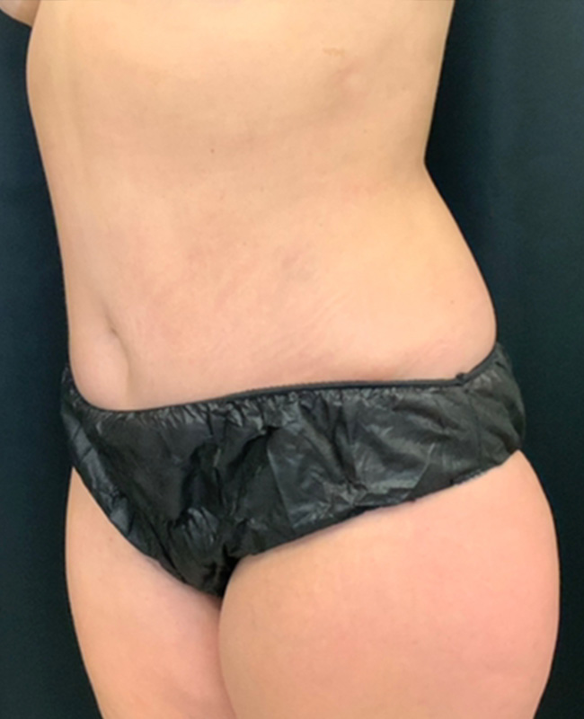 Abdominoplasty Before and After | Montilla Plastic Surgery 