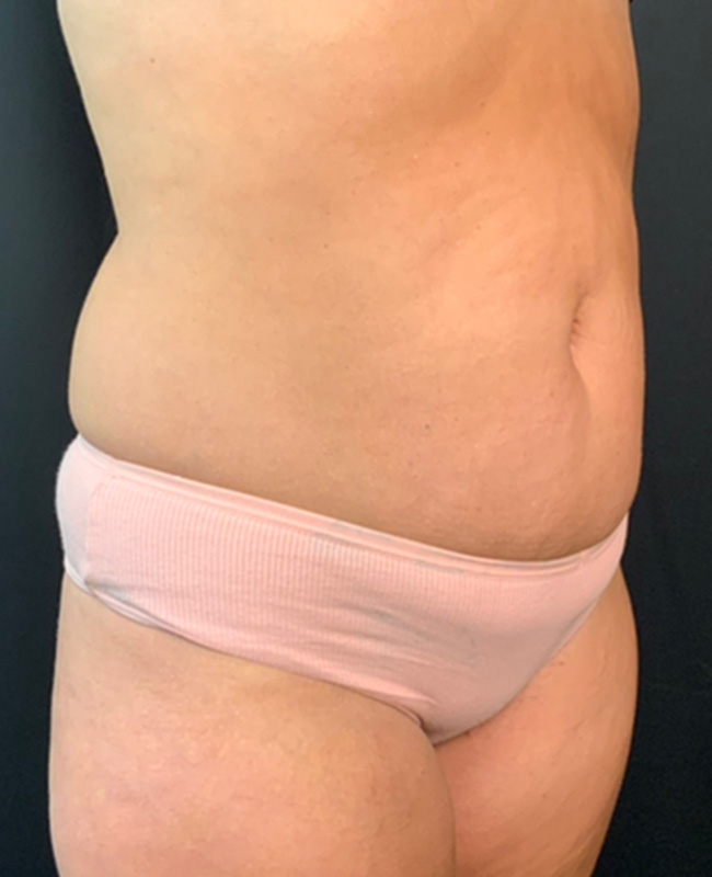 Abdominoplasty Before and After | Montilla Plastic Surgery 