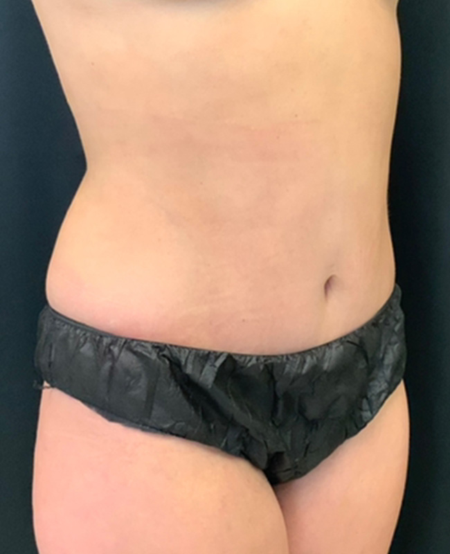 Abdominoplasty Before and After | Montilla Plastic Surgery 