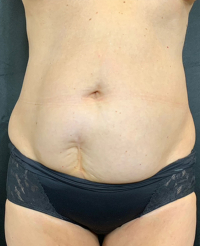 Abdominoplasty Before and After | Montilla Plastic Surgery 