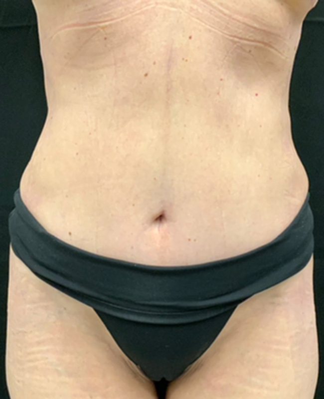 Abdominoplasty Before and After | Montilla Plastic Surgery 