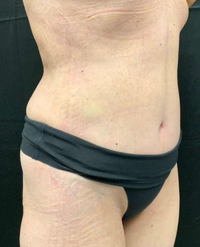 Abdominoplasty Before and After | Montilla Plastic Surgery 