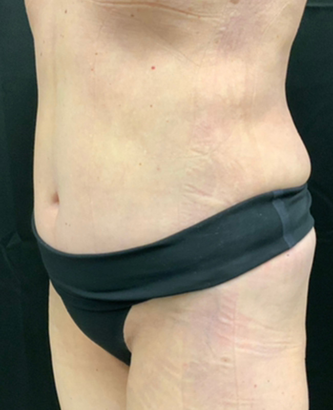 Abdominoplasty Before and After | Montilla Plastic Surgery 