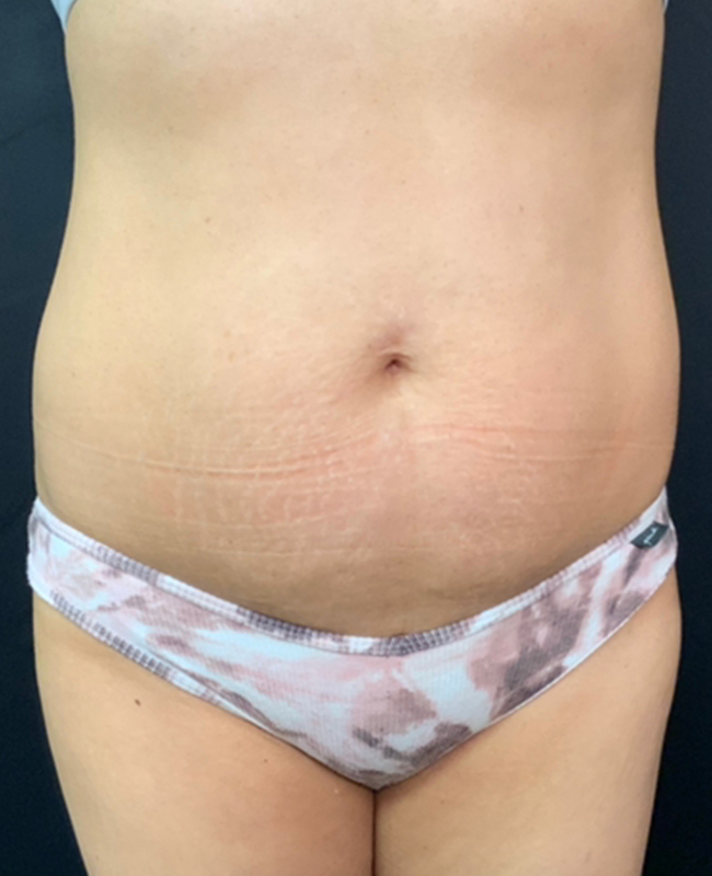 Abdominoplasty Before and After | Montilla Plastic Surgery 