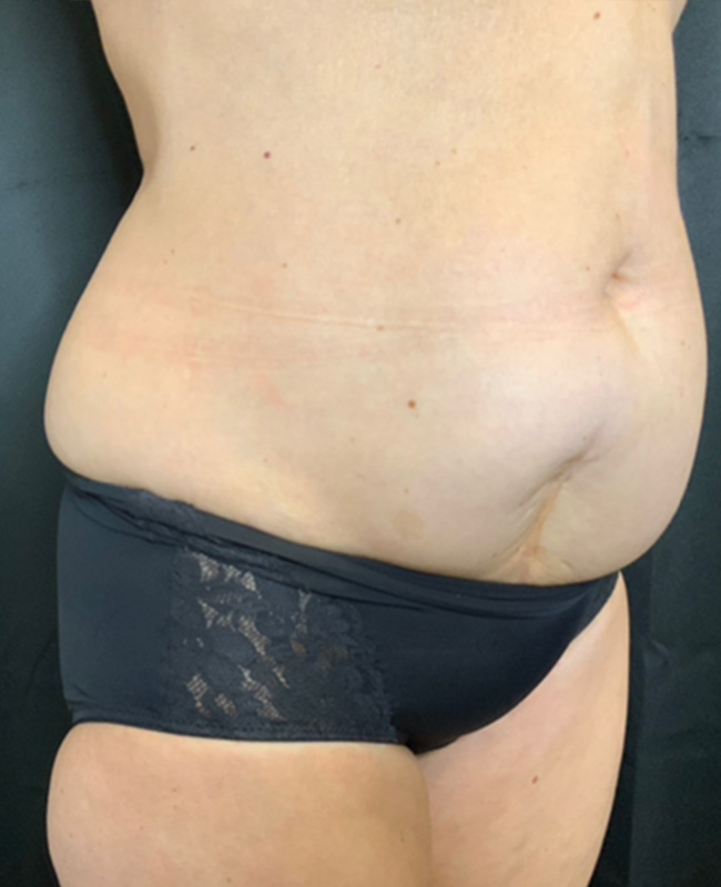 Abdominoplasty Before and After | Montilla Plastic Surgery