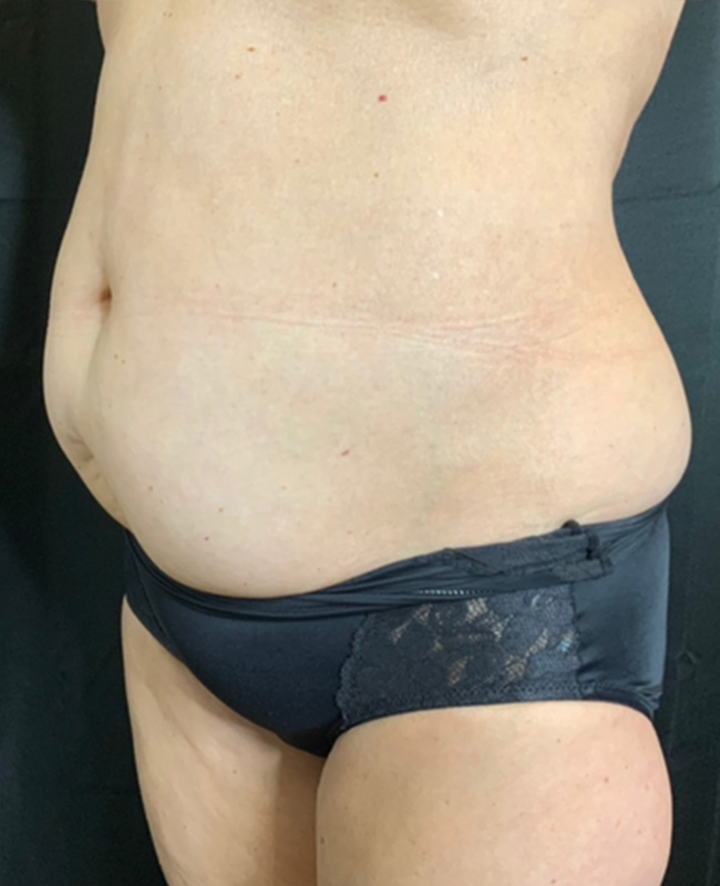 Abdominoplasty Before and After | Montilla Plastic Surgery