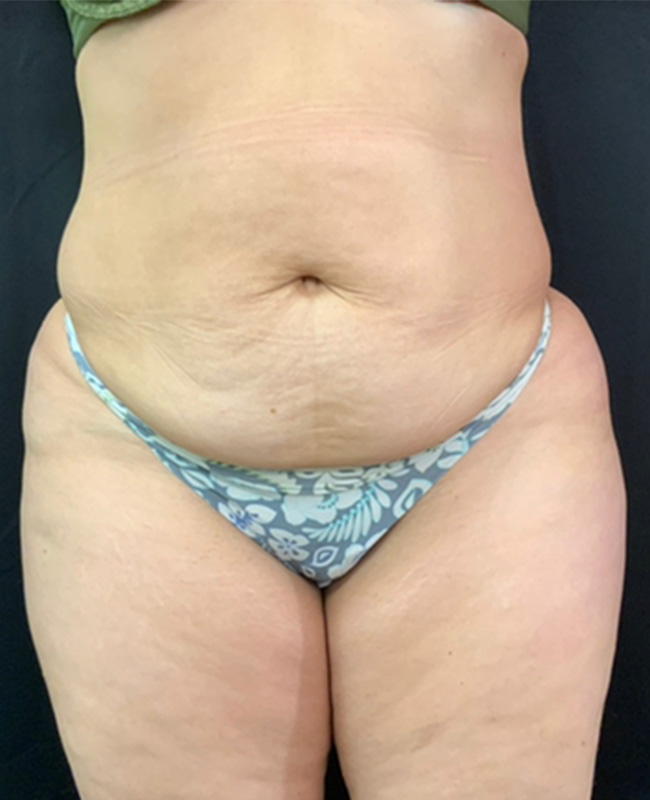Abdominoplasty Before and After | Montilla Plastic Surgery 
