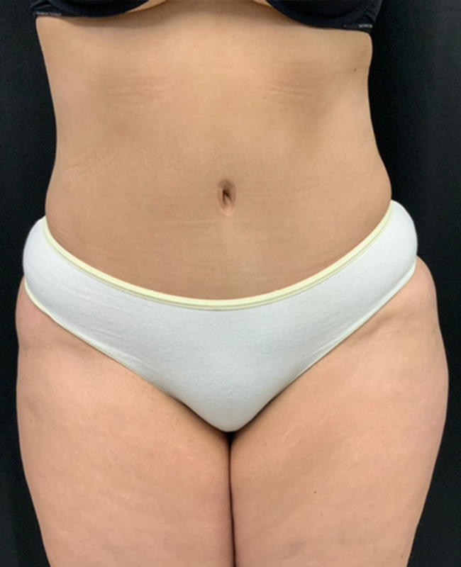 Abdominoplasty Before and After | Montilla Plastic Surgery 