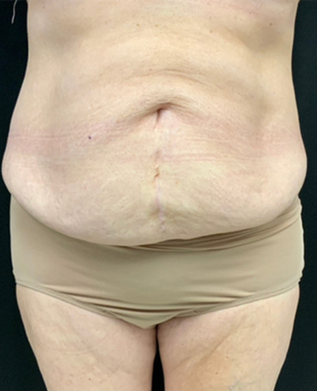 Abdominoplasty Before and After | Montilla Plastic Surgery 