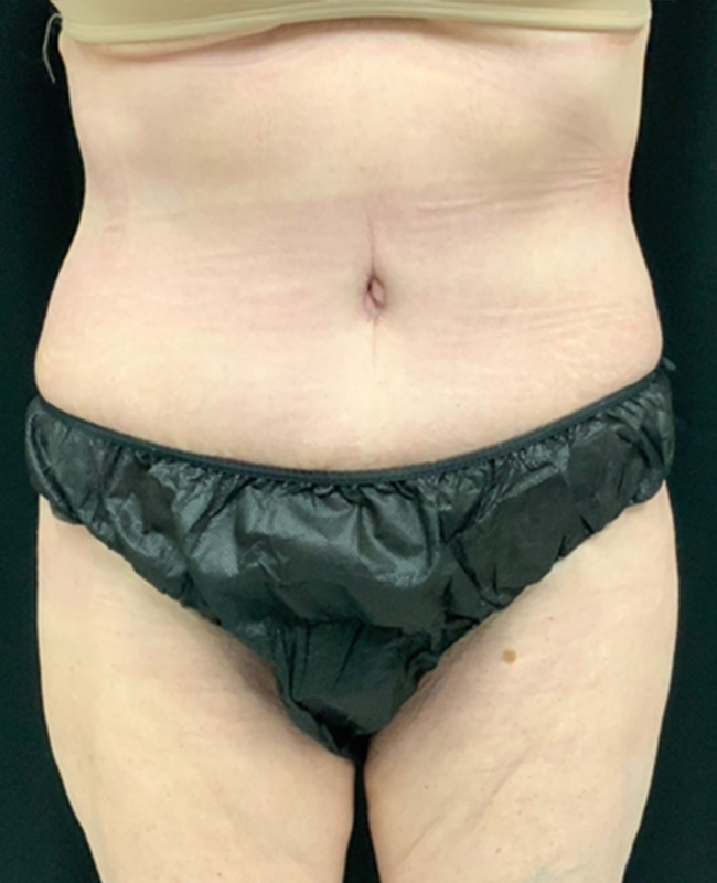 Abdominoplasty Before and After | Montilla Plastic Surgery 