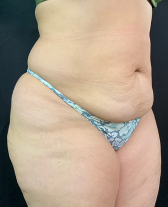 Abdominoplasty Before and After | Montilla Plastic Surgery