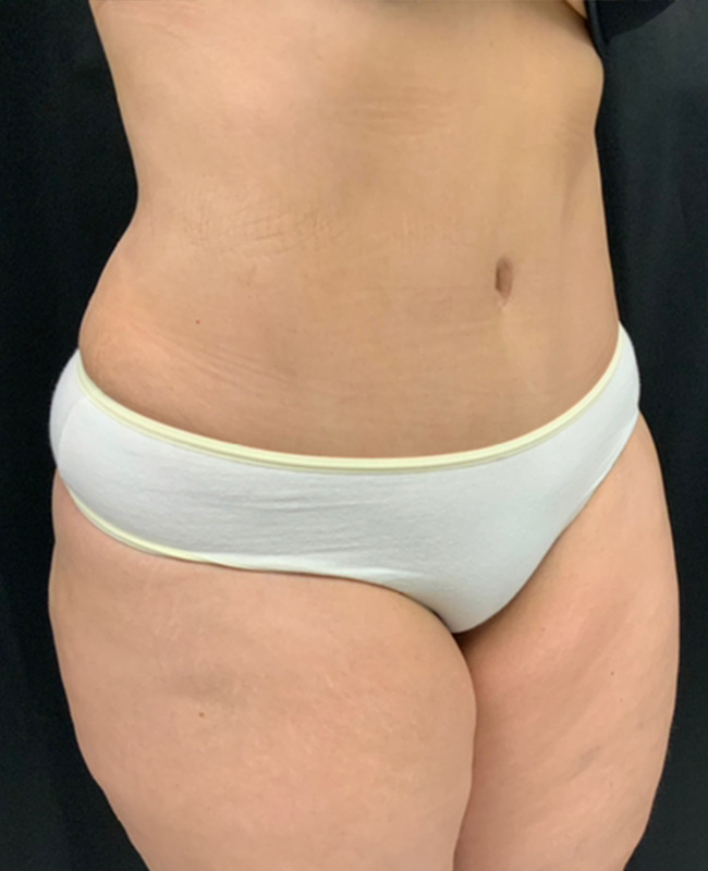 Abdominoplasty Before and After | Montilla Plastic Surgery