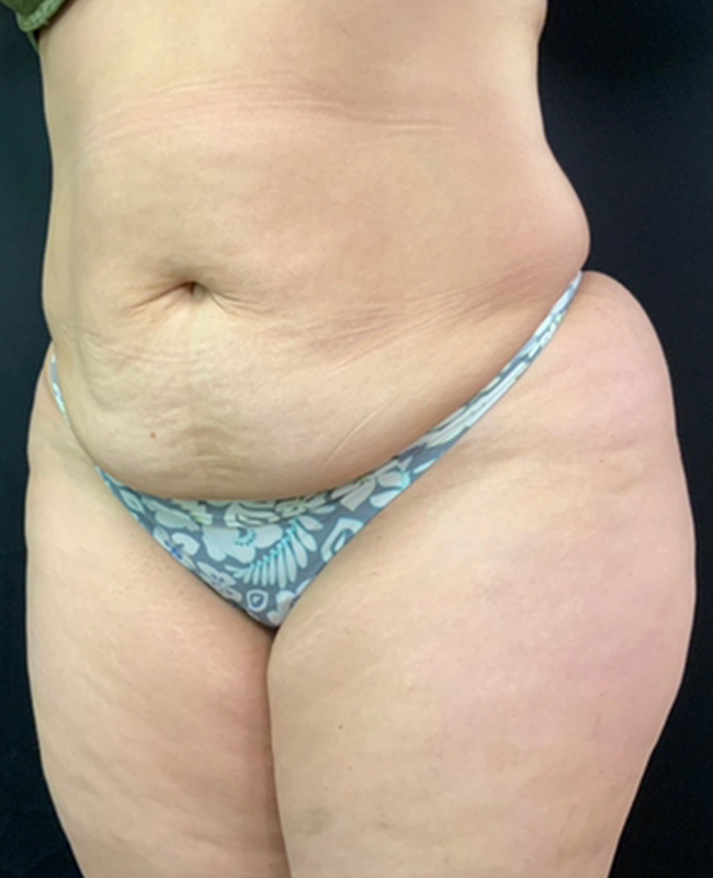 Abdominoplasty Before and After | Montilla Plastic Surgery