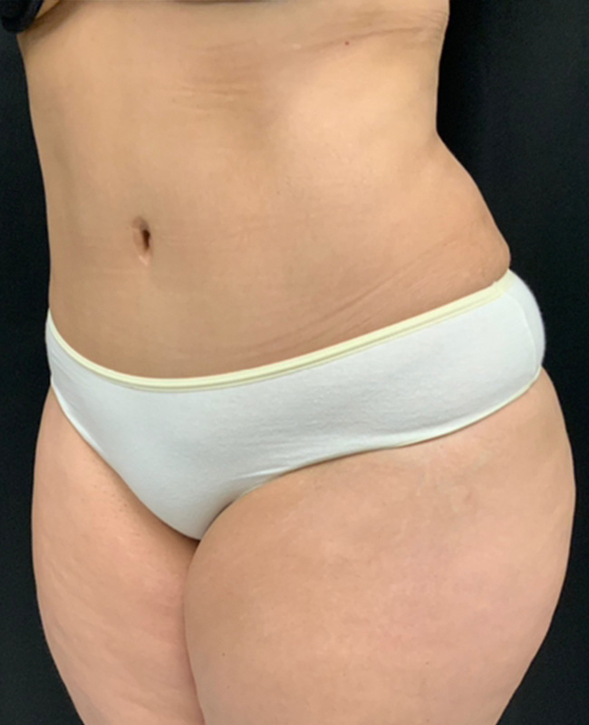 Abdominoplasty Before and After | Montilla Plastic Surgery