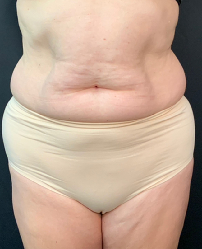 Abdominoplasty Before and After | Montilla Plastic Surgery 