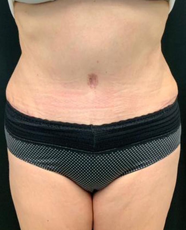 Abdominoplasty Before and After | Montilla Plastic Surgery 