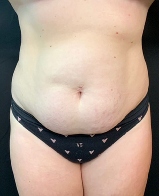 Abdominoplasty Before and After | Montilla Plastic Surgery 