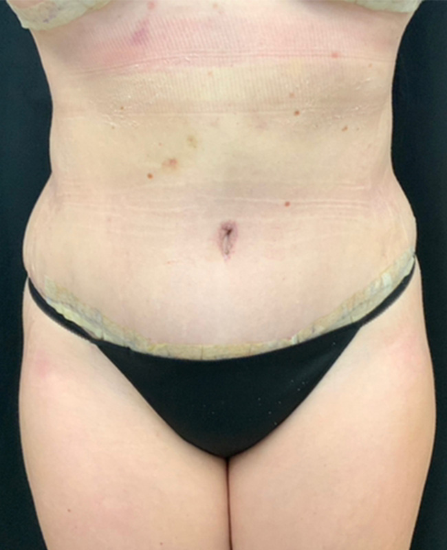 Abdominoplasty Before and After | Montilla Plastic Surgery 