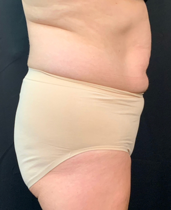 Abdominoplasty Before and After | Montilla Plastic Surgery