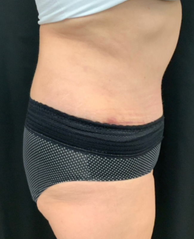 Abdominoplasty Before and After | Montilla Plastic Surgery