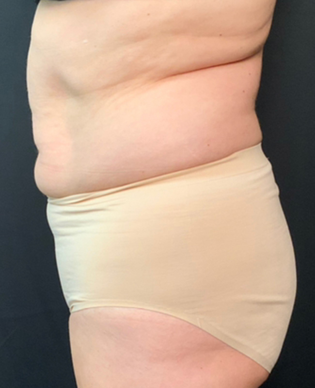 Abdominoplasty Before and After | Montilla Plastic Surgery