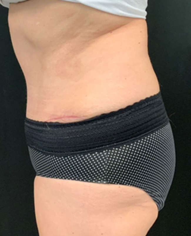 Abdominoplasty Before and After | Montilla Plastic Surgery