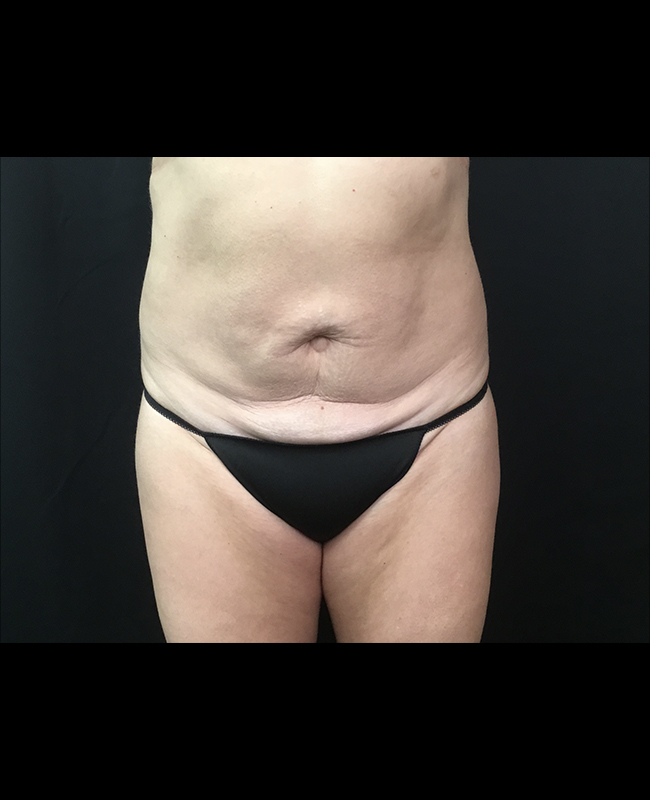 Abdominoplasty Before and After | Montilla Plastic Surgery 
