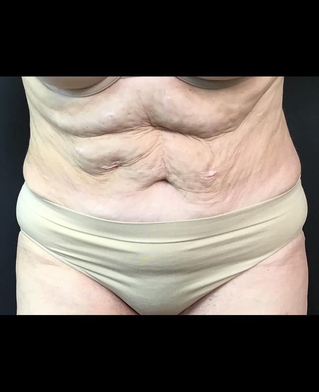Abdominoplasty Before and After | Montilla Plastic Surgery 