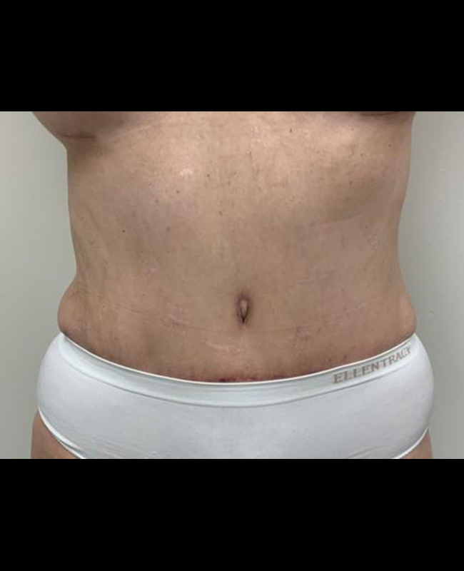 Abdominoplasty Before and After | Montilla Plastic Surgery 