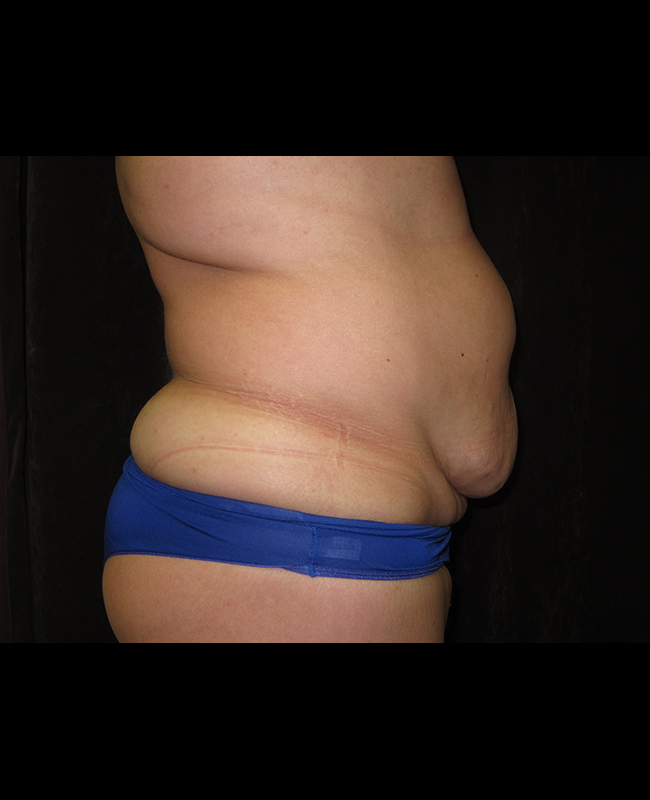 Abdominoplasty Before and After | Montilla Plastic Surgery 