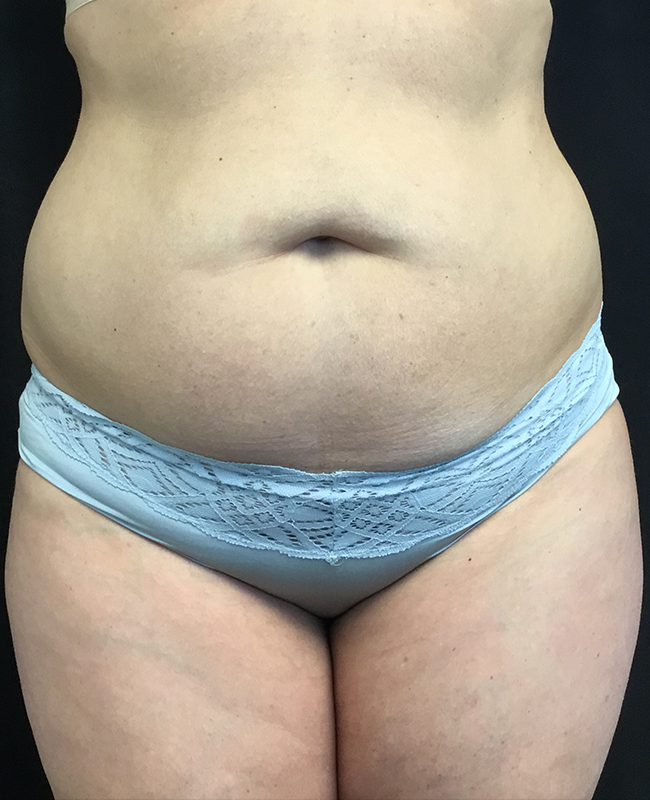 Abdominoplasty Before and After | Montilla Plastic Surgery 