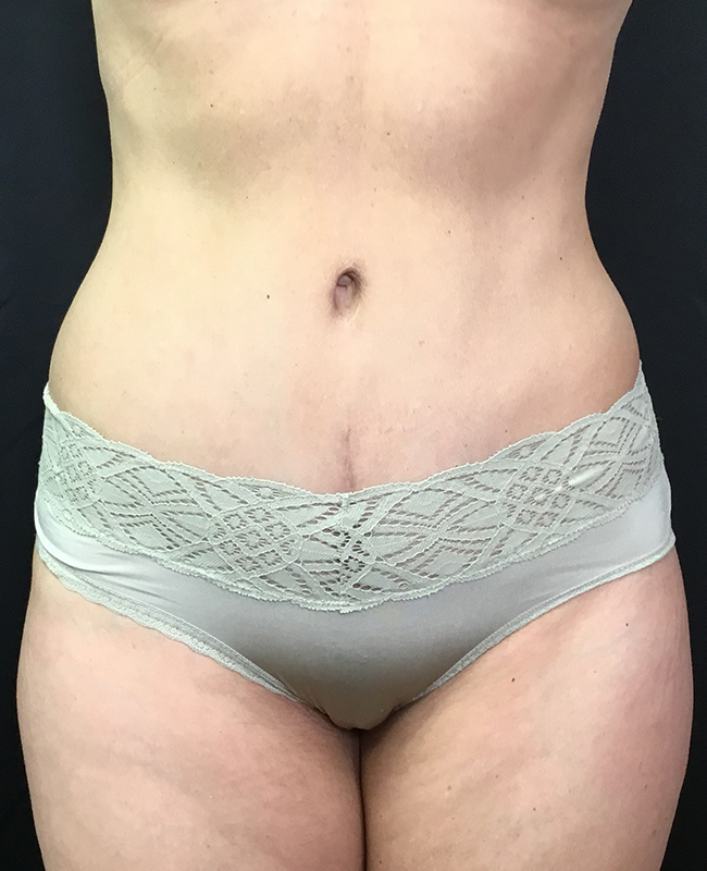 Abdominoplasty Before and After | Montilla Plastic Surgery 