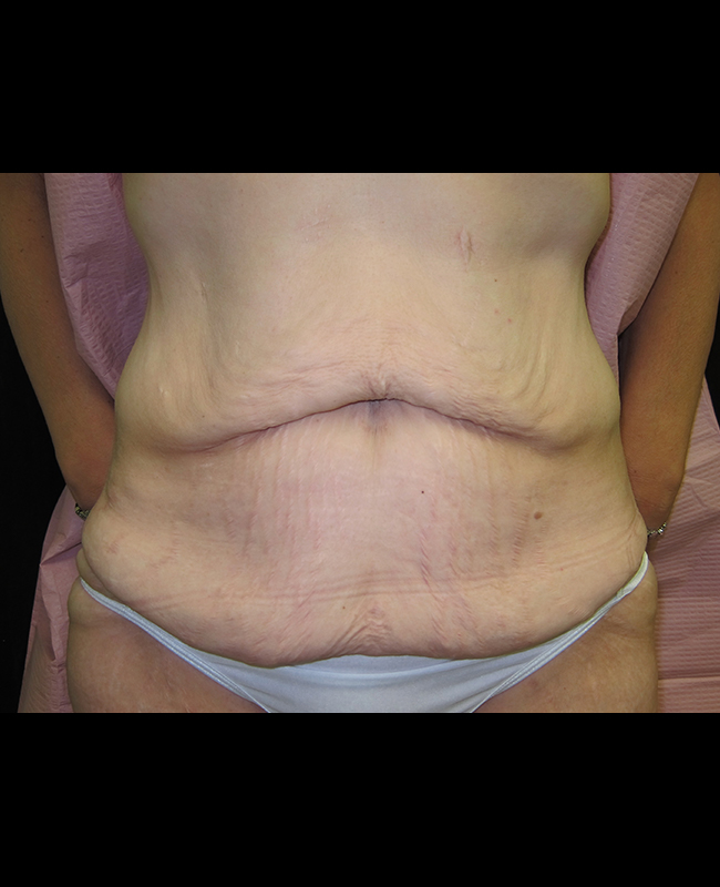 Abdominoplasty Before and After | Montilla Plastic Surgery 