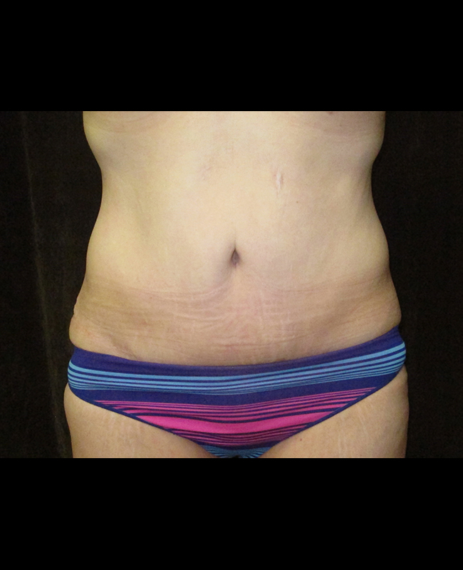 Abdominoplasty Before and After | Montilla Plastic Surgery 