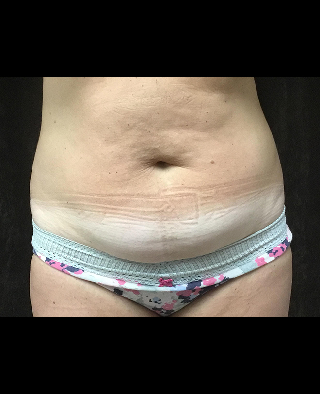 Abdominoplasty Before and After | Montilla Plastic Surgery 