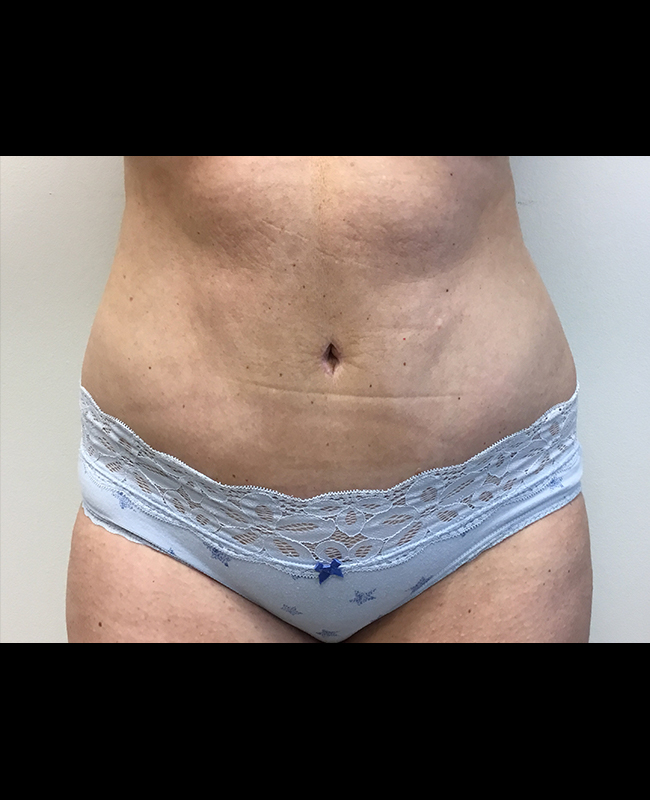 Abdominoplasty Before and After | Montilla Plastic Surgery 